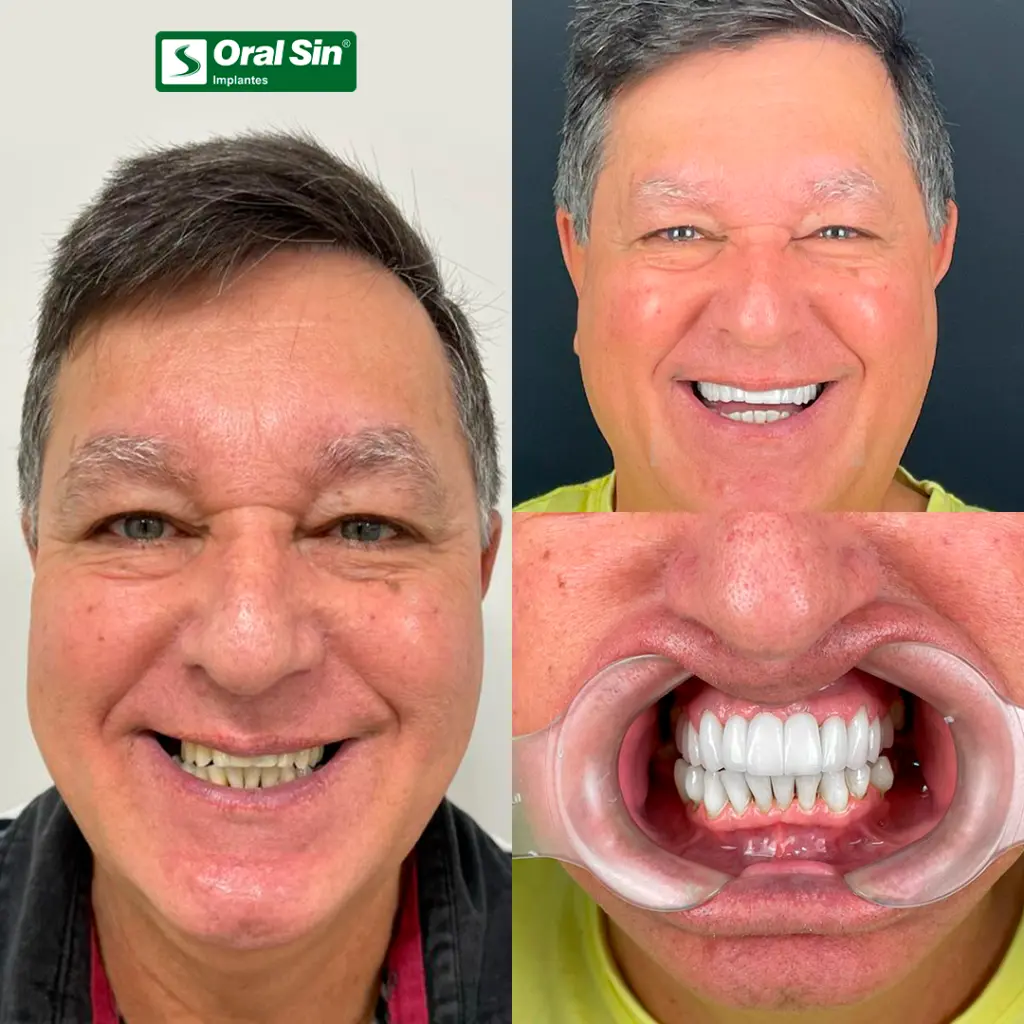 Antes & depois — implante completo